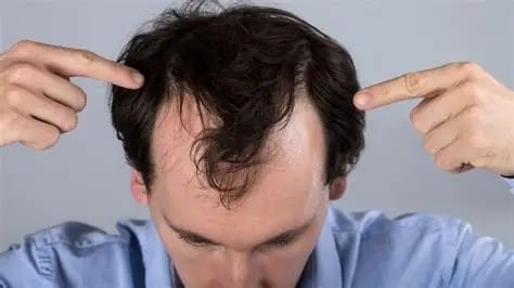 Hair loss